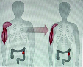 Figure 7: Sarcopenia